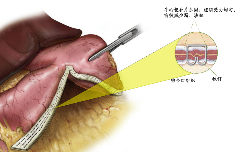 防渗漏，促愈合-Stake医疗消化外科生物补片注册临床试验入组正式完成